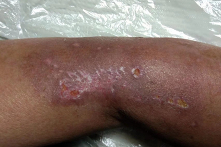 慢性湿疹胳膊糜烂图