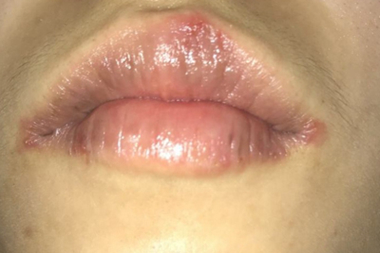 口唇疱疹嘴唇上有几块红斑图