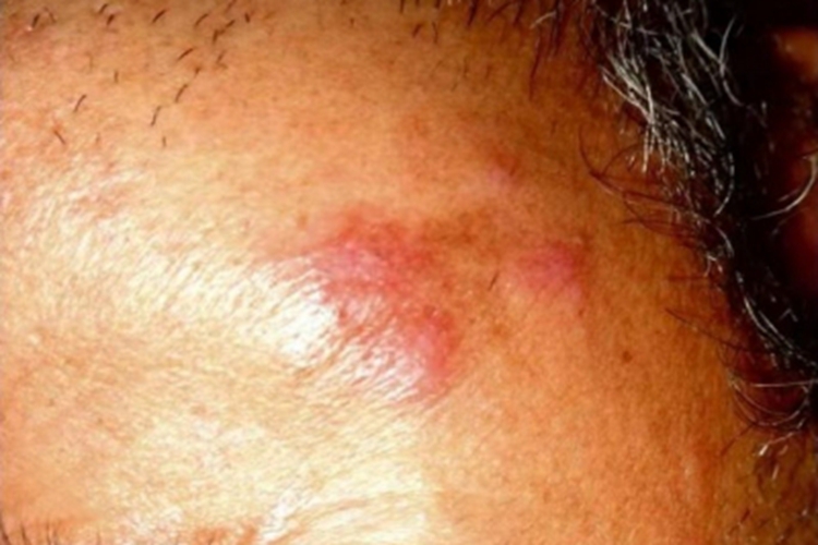 皮肤淋巴细胞浸润症前额症状图 皮肤淋巴细胞浸润症前额症状图