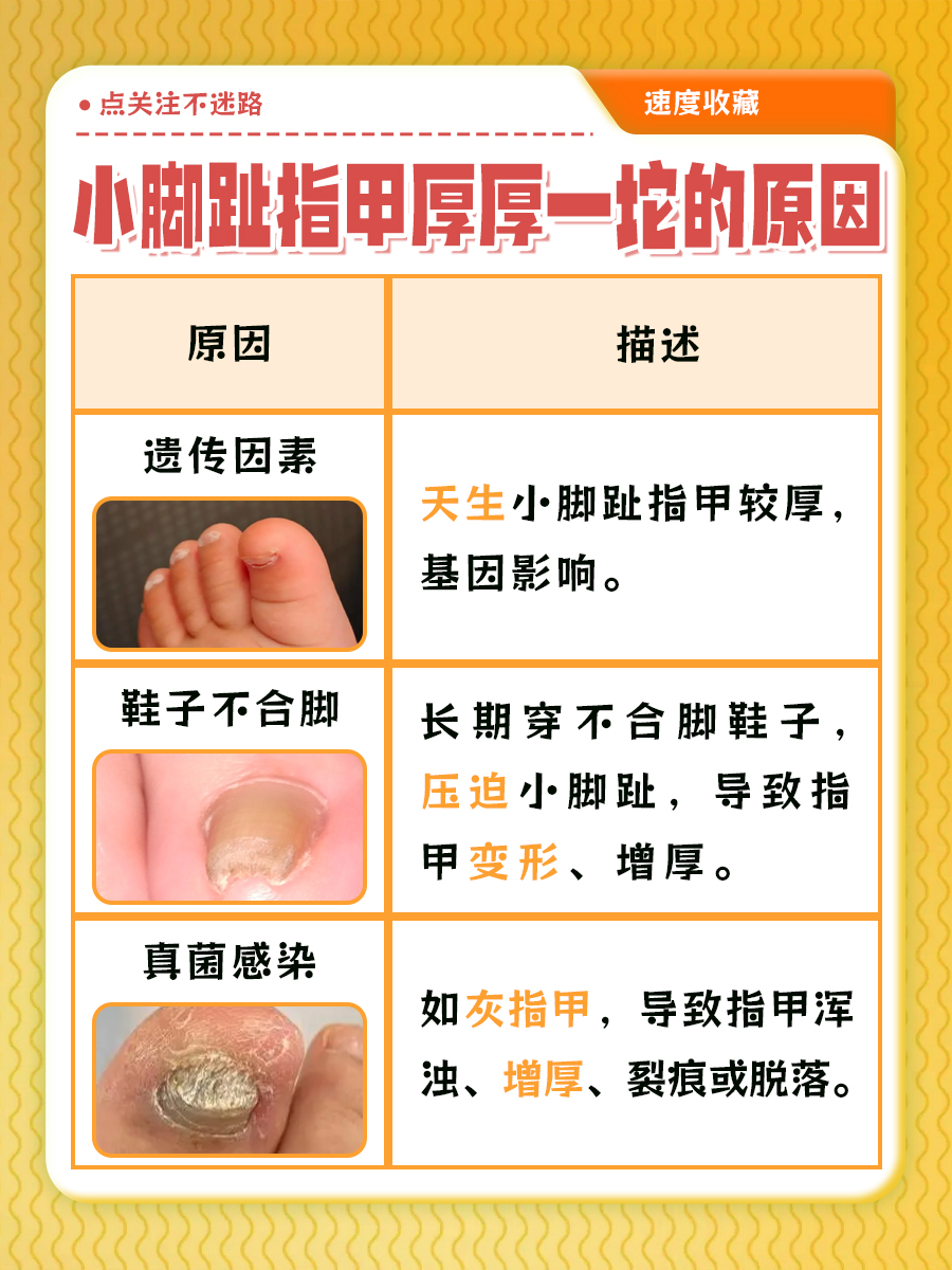 小脚趾指甲厚厚一坨？医生分析究竟是何原因