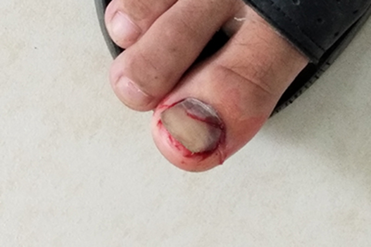 外伤脚趾甲症状图