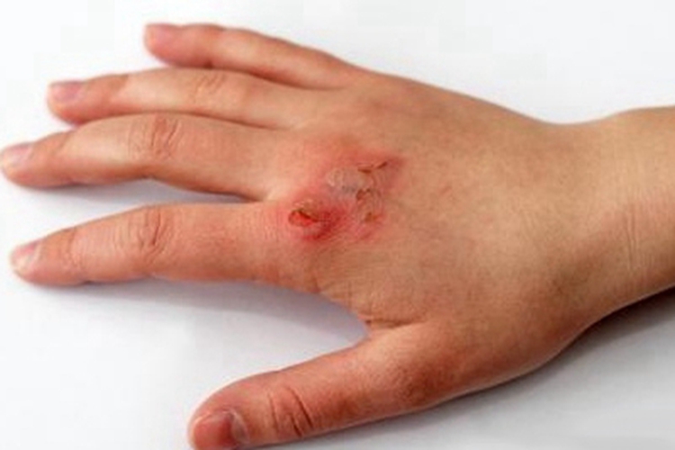 脓疱疮手背红斑图