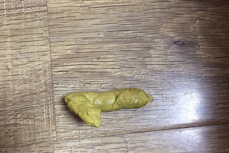 黄疸型肝炎淡黄色大便图