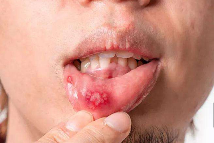 过敏性接触性口炎红斑图