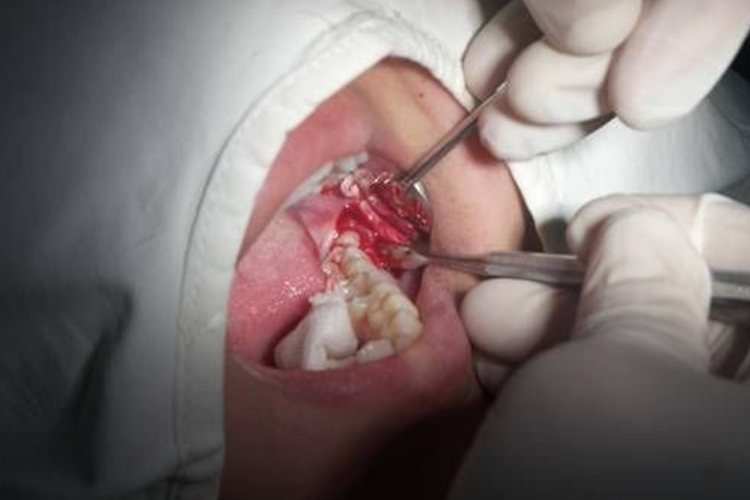 近中阻生智齿拔除过程图解