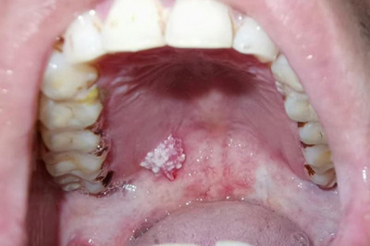 口腔尖锐湿疣口腔症状图