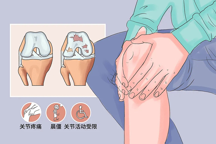 膝关节炎图