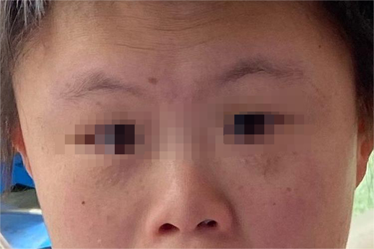 小儿唐氏综合征图