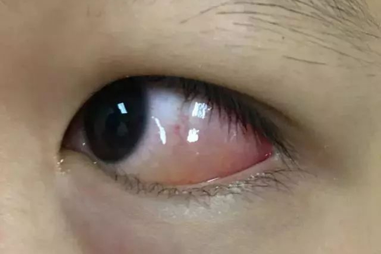 球结膜水肿图