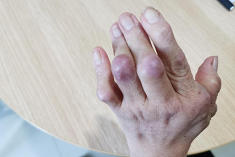 类风湿关节炎小红疙瘩图