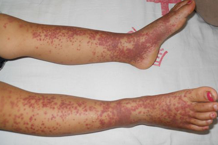 关节型过敏性紫癜图 关节型过敏性紫癜图