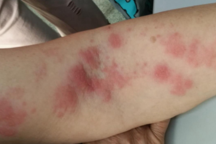 带状疱疹胳膊丘疹红斑图 带状疱疹胳膊丘疹红斑图