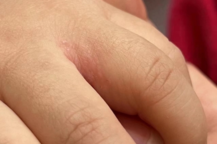 浸渍糜烂型手癣手指缝红肿图 浸渍糜烂型手癣手指缝红肿图