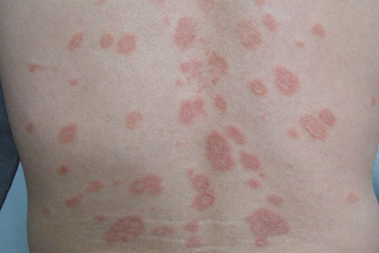 腰上玫瑰糠疹图 腰上玫瑰糠疹图