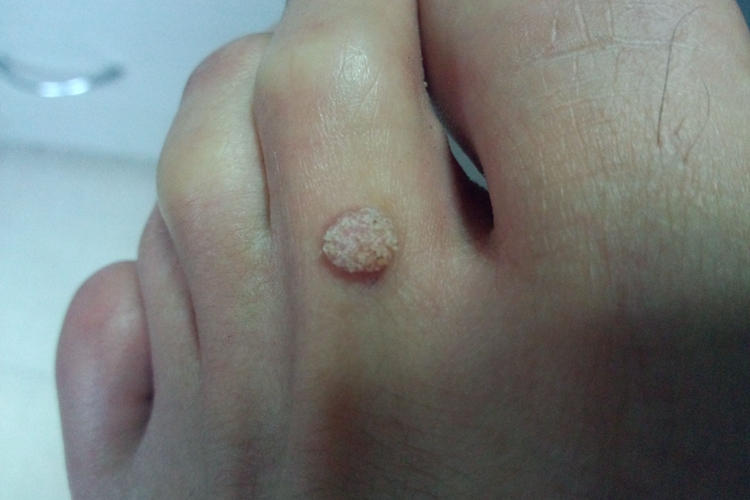 脚上长了跖疣图 脚上长了跖疣图