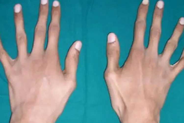 马方综合征手指特别长图