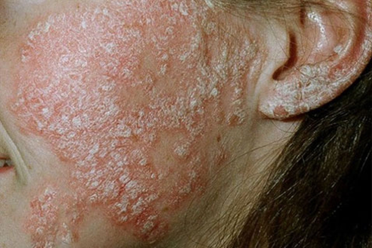 银屑病面部丘疹图 银屑病面部丘疹图