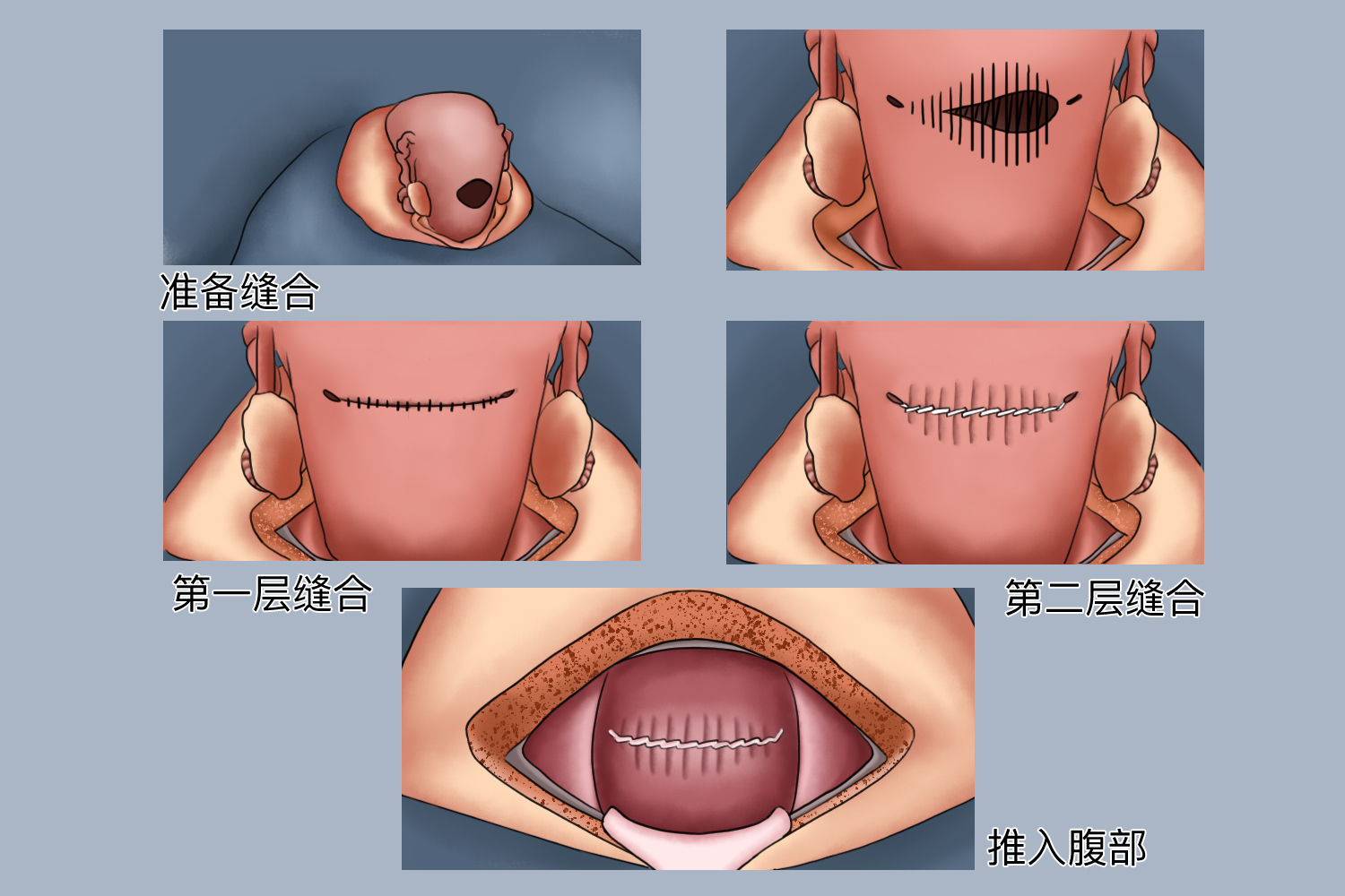 子宫下段形成图片