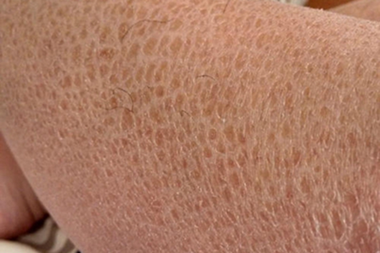 板层状鱼鳞病小腿裂纹图