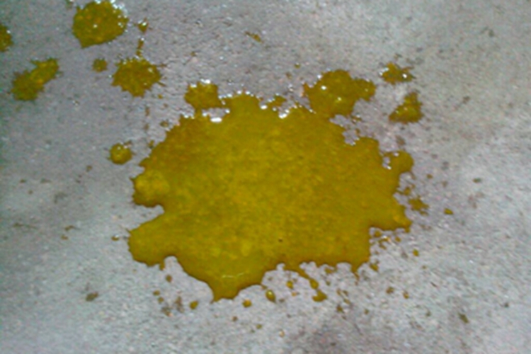 旋毛虫病拉水样便图 旋毛虫病拉水样便图