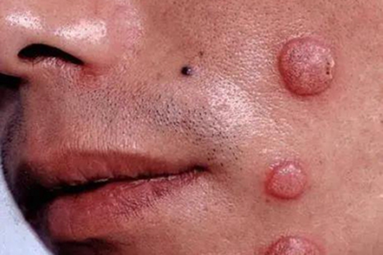 颌面部梅毒面部症状图 颌面部梅毒面部症状图