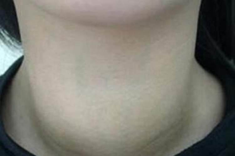 单纯性甲状腺肿鼓起个大包图 单纯性甲状腺肿鼓起个大包图