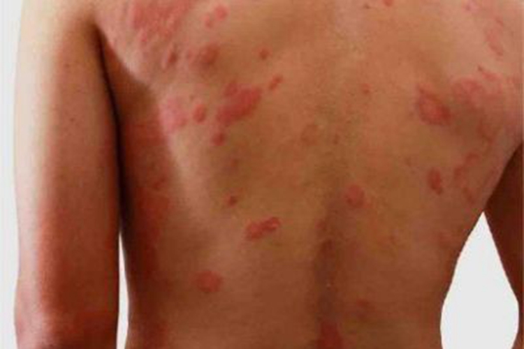 毛发红糠疹性红皮病背部红斑图