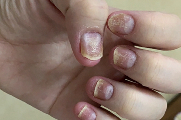 银屑病甲增厚图 银屑病甲增厚图