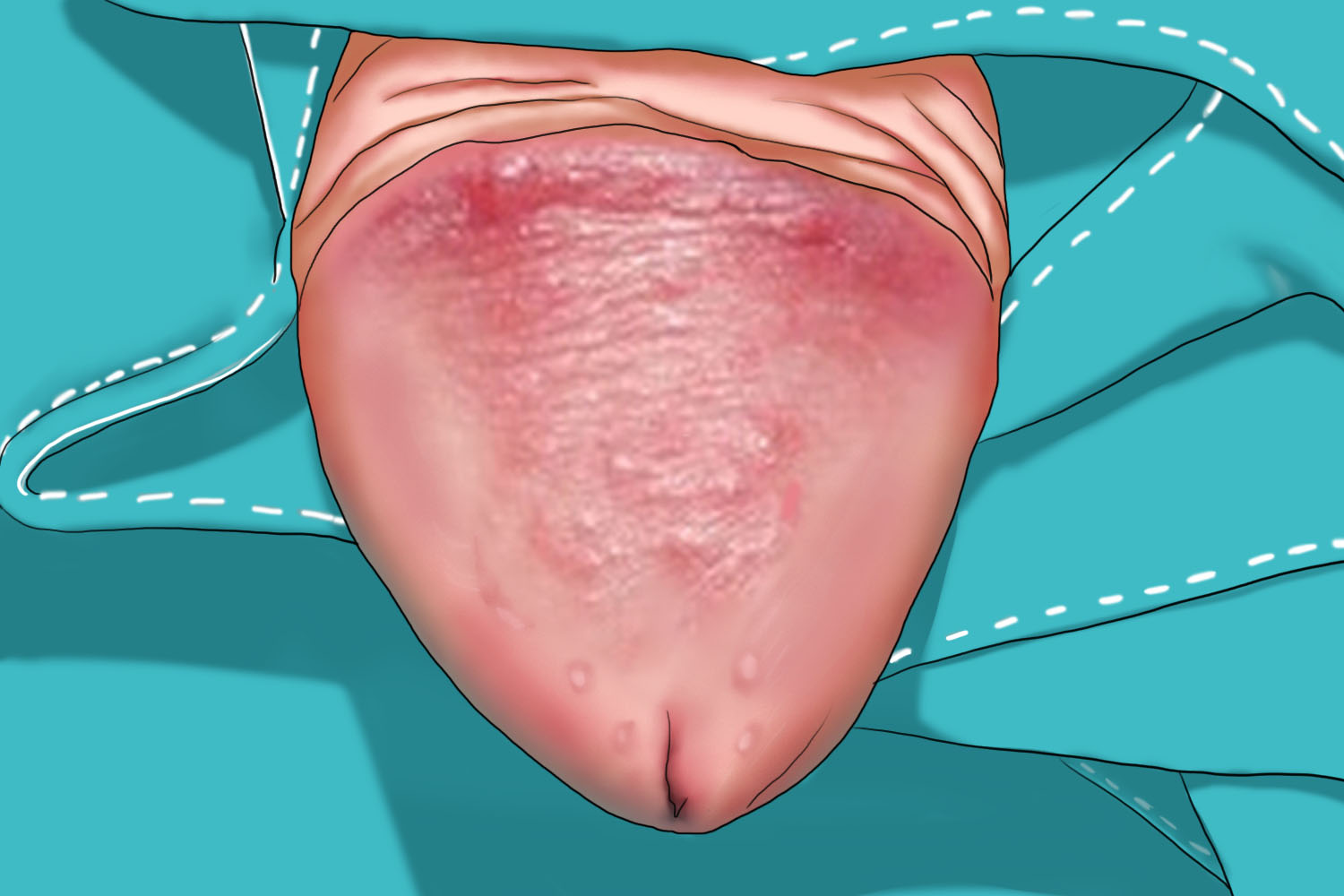 男性生殖器疱疹龟头症状图