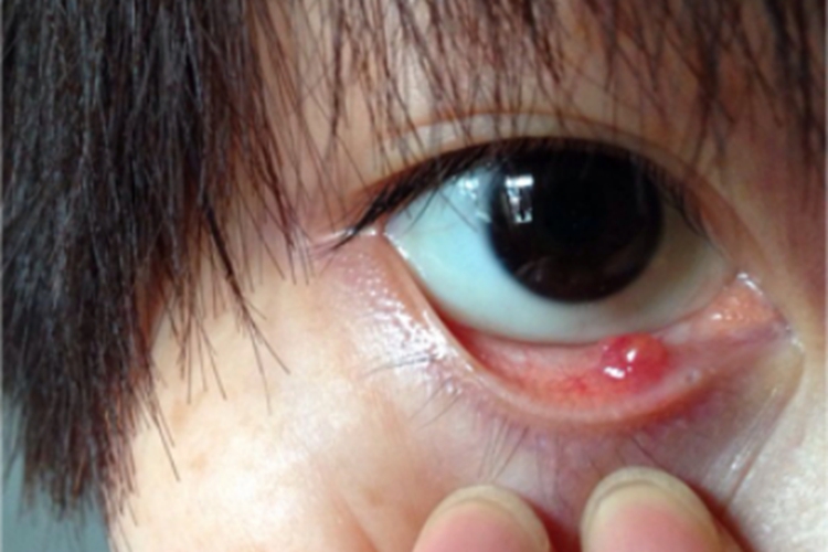 内睑腺炎眼睑小红疙瘩图