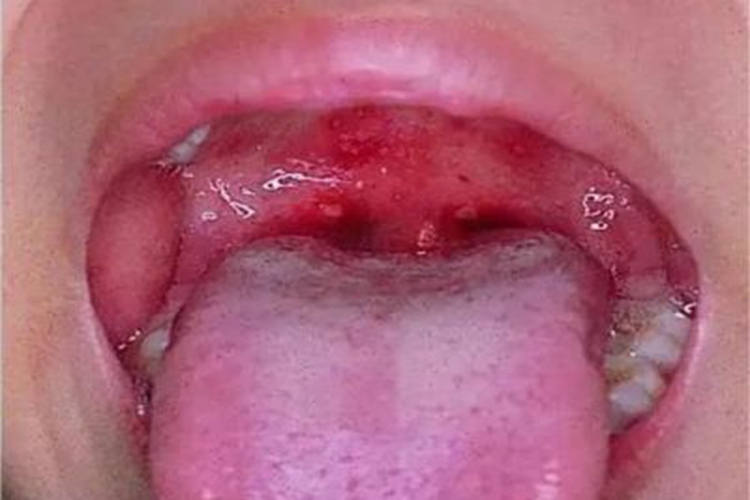 淋菌性咽炎咽喉小水疱图 淋菌性咽炎咽喉小水疱图