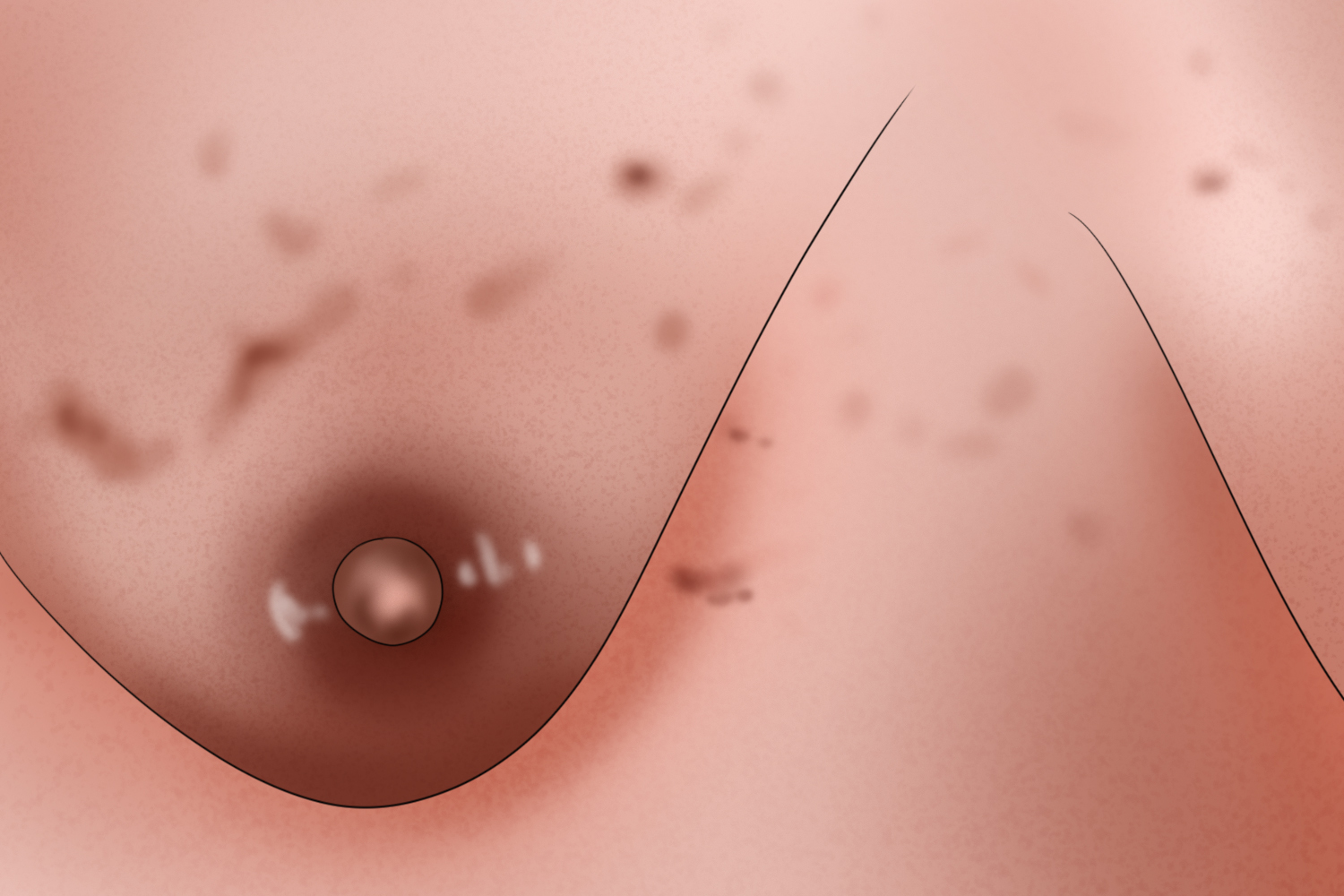 乳房湿疹亚急性期乳房手绘图