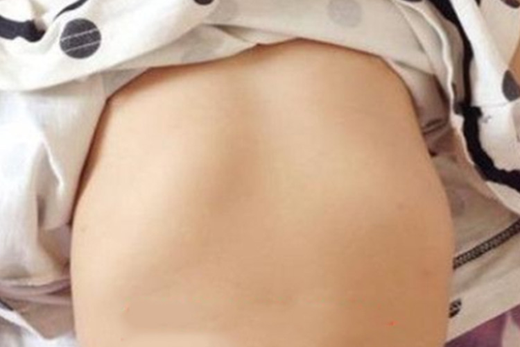 婴幼儿缺钙鸡胸图 婴幼儿缺钙鸡胸图