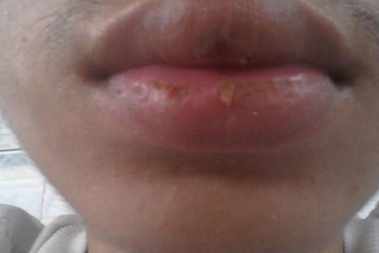 肉芽肿性唇炎水肿图
