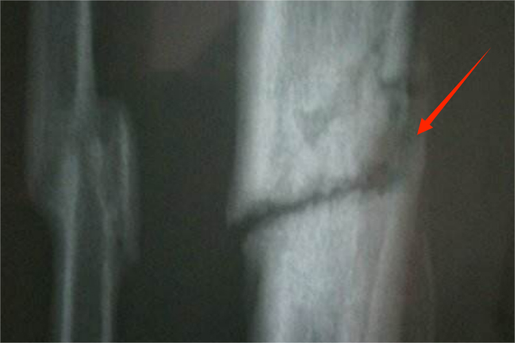 小腿胫骨骨折骨痂图