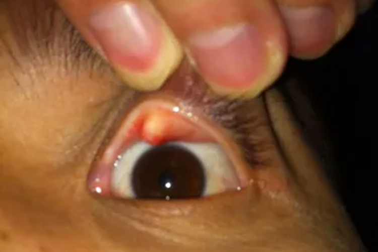 内睑腺炎起大疙瘩图