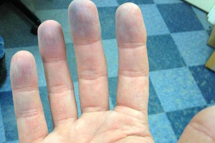 肢端发绀图 肢端发绀图