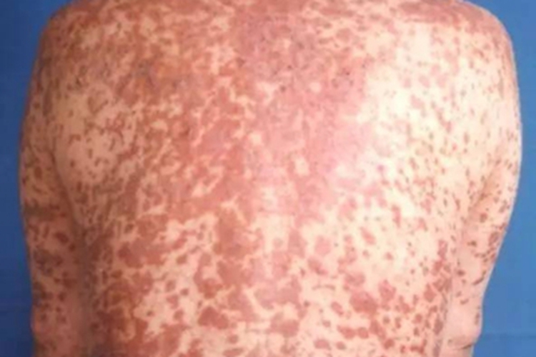 猩红热型药疹背部红斑图