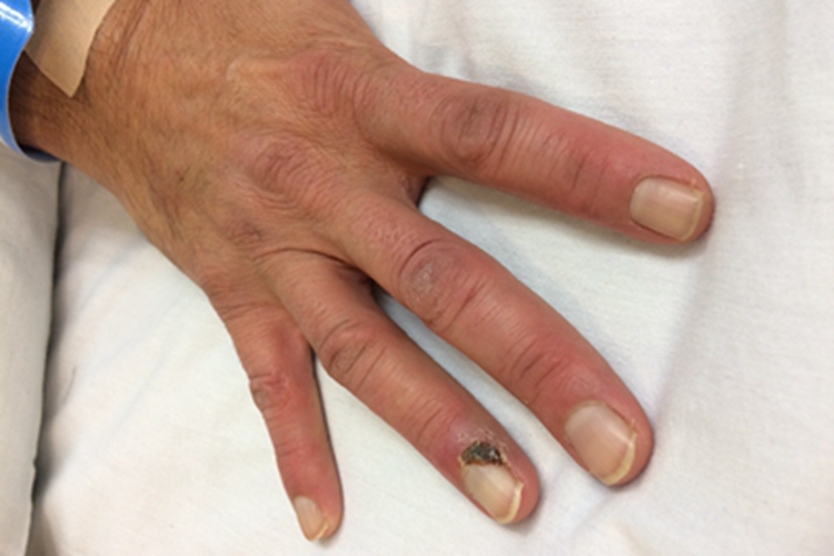 轻度血栓闭塞性脉管炎图 轻度血栓闭塞性脉管炎图