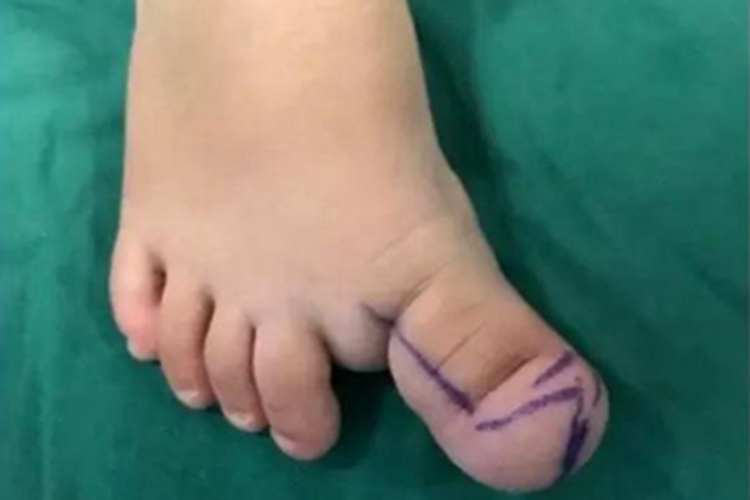 巨指畸形大脚趾肥大图