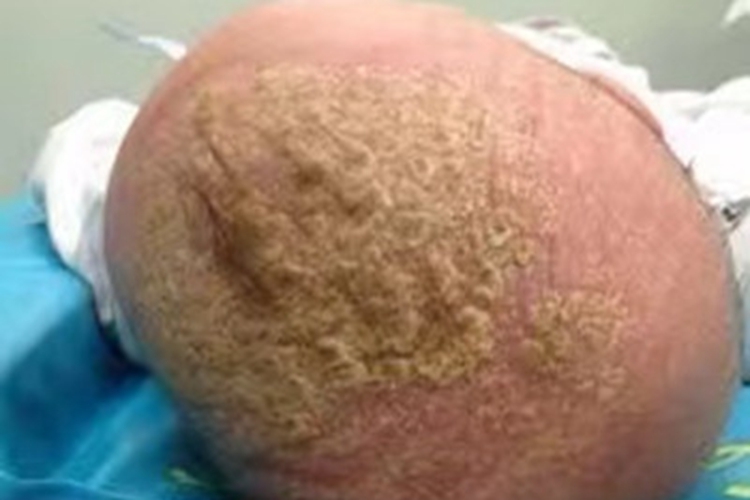 婴儿脂溢性皮炎头皮黄痂图