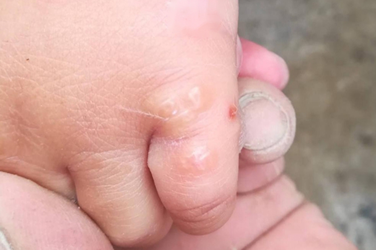 手指上起手癣有大水疱图