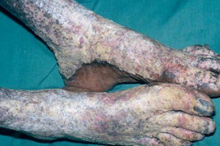 结痂性疥疮脚部脱屑图