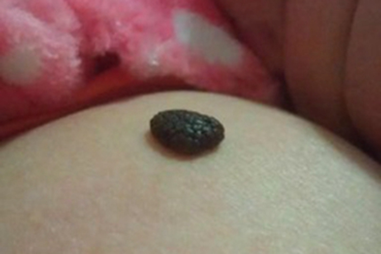 恶性黑色素瘤腹部症状图 恶性黑色素瘤腹部症状图