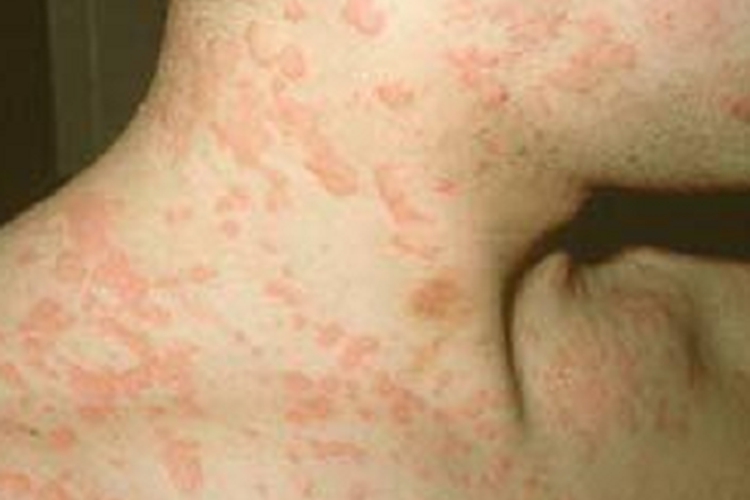 蛋白胨性荨麻疹侧颈红点图 蛋白胨性荨麻疹侧颈红点图
