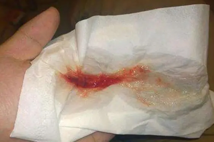 鼻腔鼻窦恶性肿瘤脓血鼻涕图