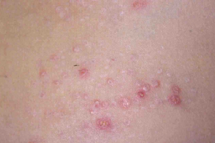 皮排银屑病样皮疹图