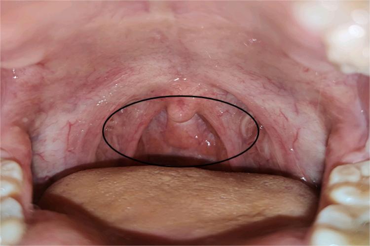 长期舌根淋巴滤泡增生图