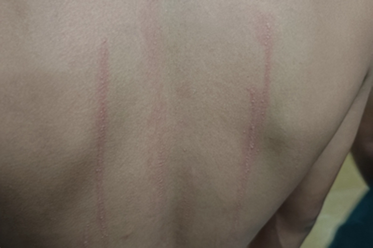 人工荨麻疹红斑图 人工荨麻疹红斑图