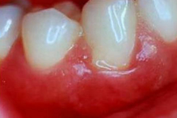 牙龈炎牙龈充血肿大图 牙龈炎牙龈充血肿大图